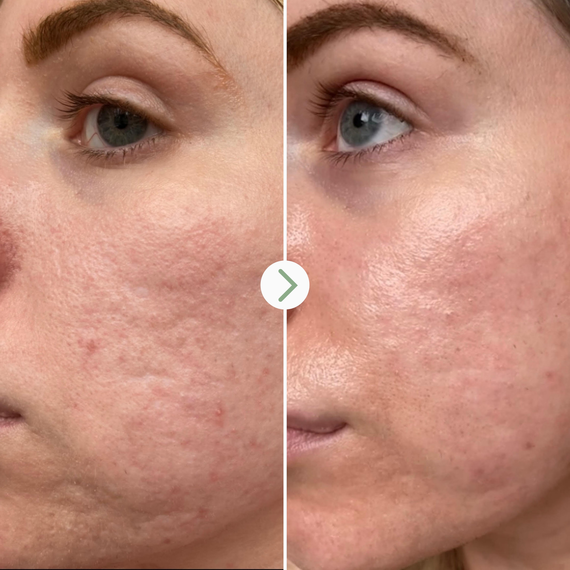 Pai Skincare - Acide Hyaluronique - Booster Hydratant - image 5